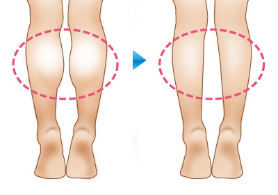 NICR（ふくらはぎ痩身）施術前後のイメージ